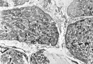 M,4m. | rhabdomyosarcoma in retented testis